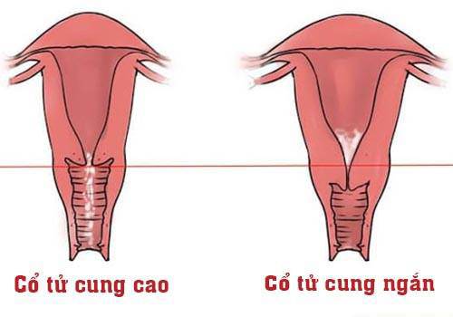 Hình ảnh cổ tử cung ngắn (hình phải).