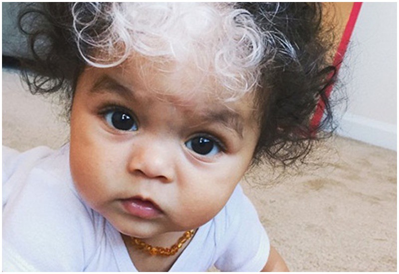 Một cô bé từng thu hút sự chú ý khi sinh ra với hai màu tóc và hai màu da trắng - đen khác nhau. Đây là một hội chứng có tên là poliosis, gây ra bởi sự thiếu sắc tố về tóc và da.
