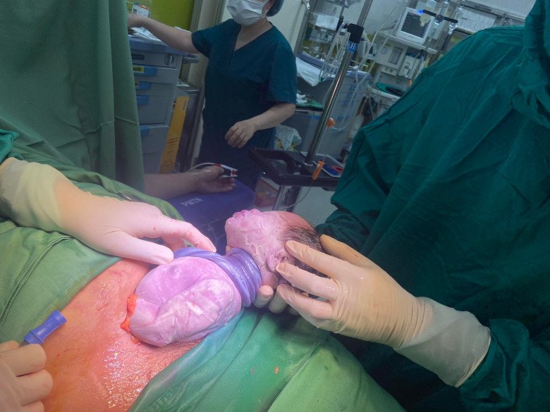 Bé trai đã chào đời an toàn mặc dù bị dây rốn quấn 5 vòng cổ. (Ảnh: BSCC)