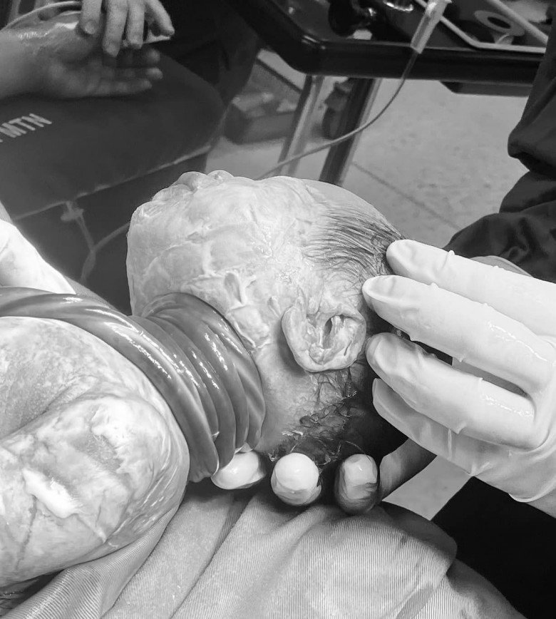 Bé trai chào đời an toàn với 5 vòng dây rốn quấn quanh cổ - 1