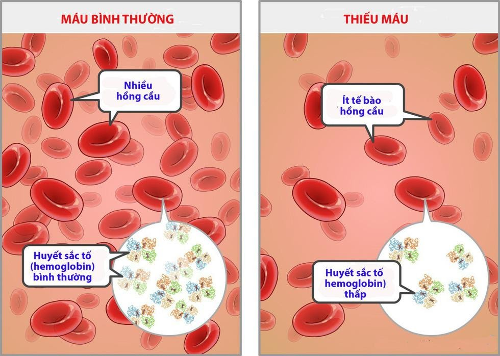 Sắt tham gia sản xuất hemoglobin, kẽm tham gia vào cấu tạo chức năng, và phát triển tạo tế bào hồng cầu. Nếu em bé chỉ tập trung nạp sắt mà thiếu yếu tố kẽm thì quá trình tạo máu không đạt hiệu quả tối ưu