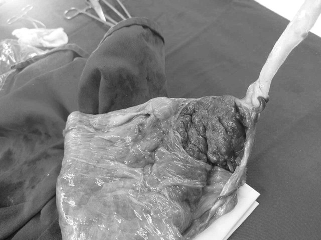 Dây rốn bám mép rìa bánh rau vỡ ối ra nhiều máu âm đạo. (ảnh BVCC)