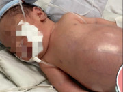 Bà bầu - Phẫu thuật cấp cứu trẻ sơ sinh bị viêm phúc mạc bào thai