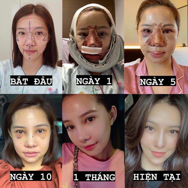 Năm 2019, Lưu Đê Ly công khai việc phẫu thuật thẩm mỹ. Mỹ nhân Người Phán Xử không ngại cập nhật tình hình của mình trên trang mạng xã hội.