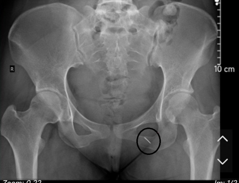 Cô dâu ở Hưng Yên được tặng “bảo bối” cứu chồng “thượng mã phong” đêm tân hôn, không ngờ chính mình phải đi cấp cứu - 1