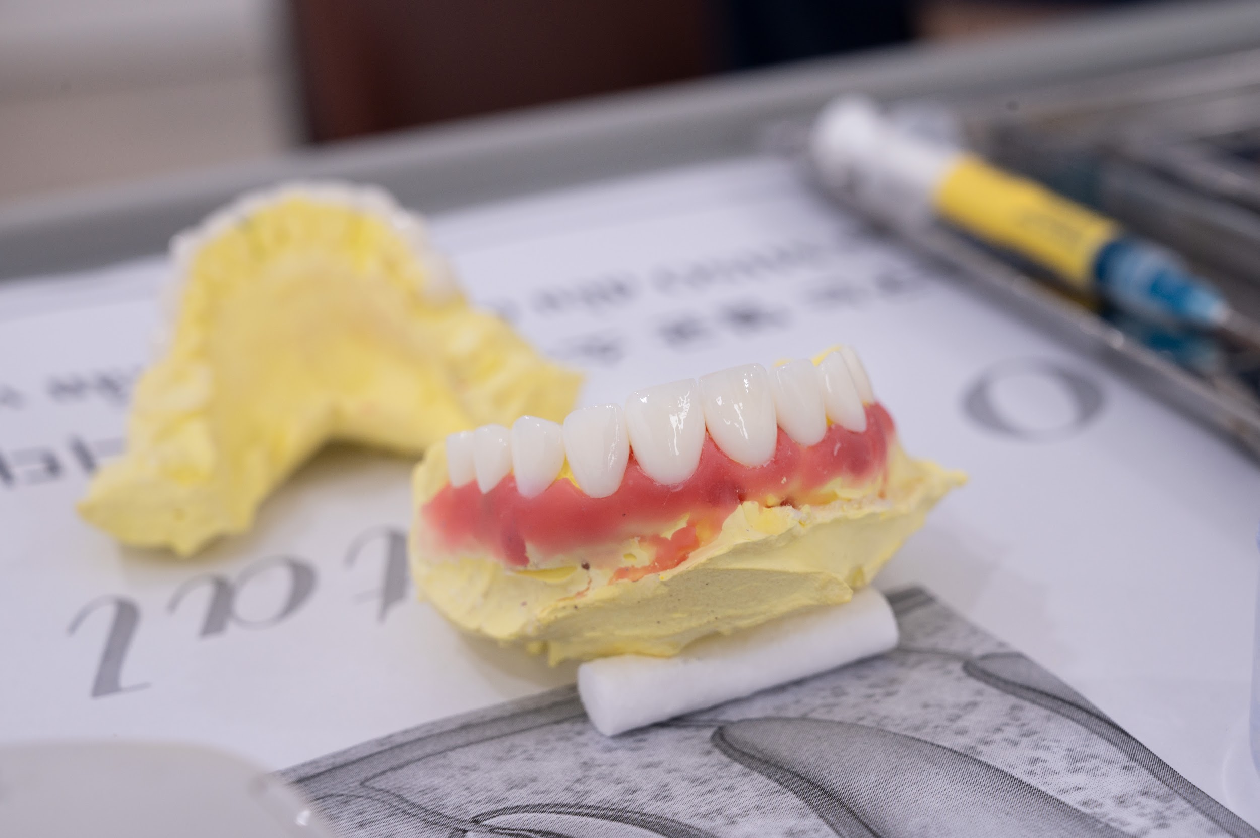 Răng sứ veneer phiên bản 0.3mm: Xu hướng thẩm mỹ răng gây sốt 2023 - 4