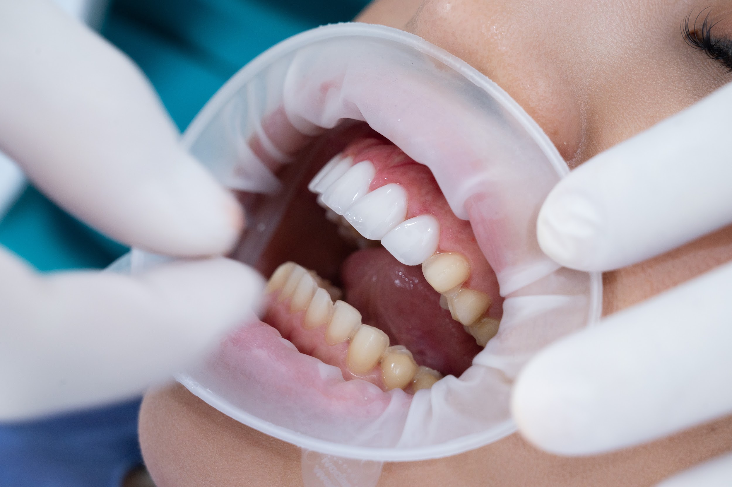 Răng sứ veneer phiên bản 0.3mm: Xu hướng thẩm mỹ răng gây sốt 2023 - 3