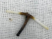 Bà bầu - Dụng cụ tránh thai "đi lạc" cắm xuyên dạ dày