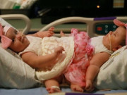 Bà bầu - Các cặp song sinh dính liền nổi tiếng trên thế giới và lý giải của giới y khoa về hiện tượng này