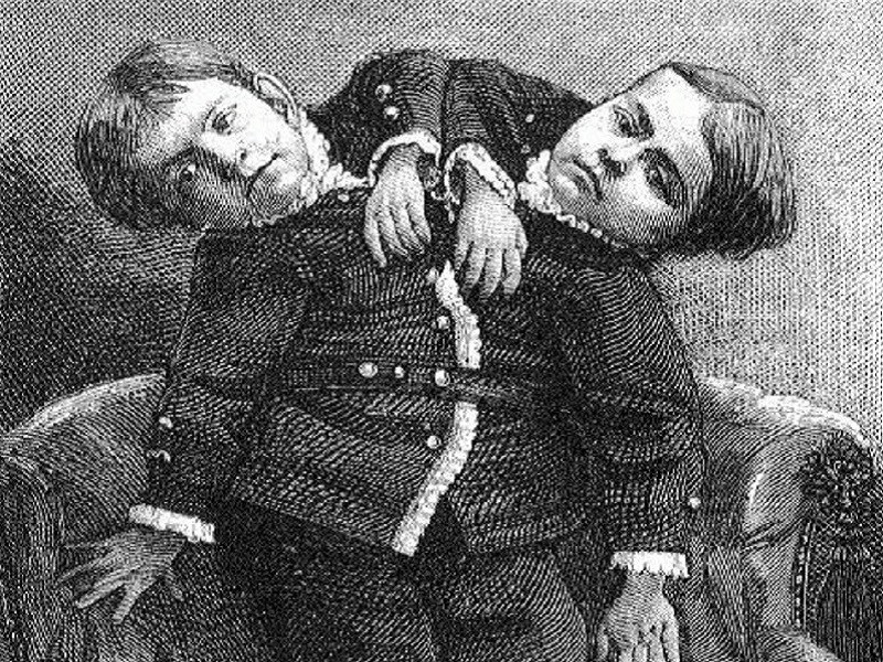1. Giacomo và Giovanni Battista dính liền ở eo, và cùng chung bụng, xương chậu và chân. Hai anh em được nghiên cứu, đi khắp nước Mỹ và châu Âu với cái tên 'Cậu bé 2 đầu'.
