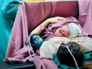 Bà bầu - Bé gái với "vòng cổ đặc biệt" hiếm gặp đã chào đời an toàn