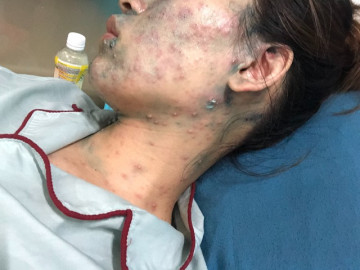 Mang thai 22 tuần phải nhập viện do tự ý dùng thuốc trị thuỷ đậu