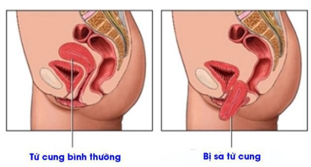 Sa sinh dục (sa tử cung) thường gặp ở phụ nữ trong độ tuổi từ 40 – 60 tuổi