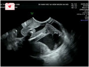 Bà bầu - Câu chuyện buồn của mẹ bầu 19 tuần bị ối thõng, siêu âm thấy chân thai nhi thò ra bên ngoài