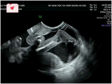 Câu chuyện buồn của mẹ bầu 19 tuần bị ối thõng, siêu âm thấy chân thai nhi thò ra bên ngoài