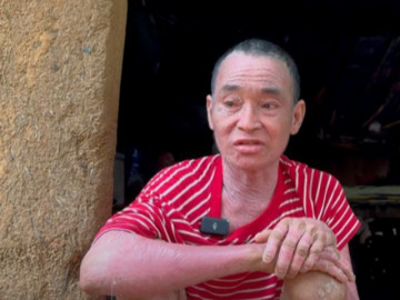 Người đàn ông toàn thân bong tróc, không dám ra ngoài vì sợ ánh nắng mặt trời, biết lý do ai cũng xót xa
