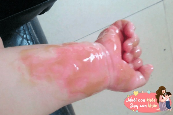 Ở nhà, bố mẹ cần tuyệt đối để trẻ tránh xa lửa và nước sôi, nếu không muốn con bị bỏng.