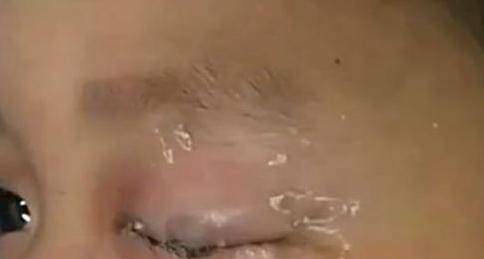 Zin zin vô tình để keo dính vào mắt, điều này sẽ vô cùng nguy hiểm nếu không được xử lý kịp thời (Ảnh: Sohu).