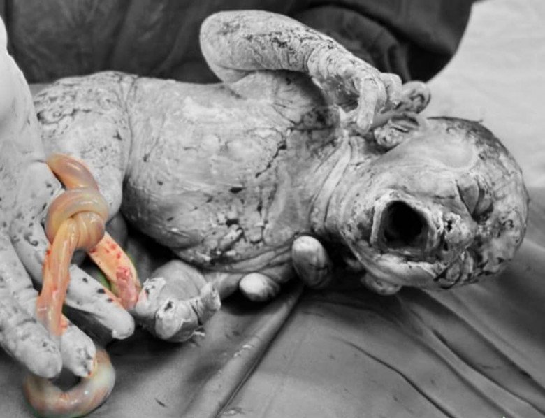 Khi mổ cho 2 sản phụ trên, cả bác sĩ Cường và ê kíp mổ cũng rất bất ngờ vì thai nhi của họ bị dây rốn thắt nút. (Ảnh: BSCC)