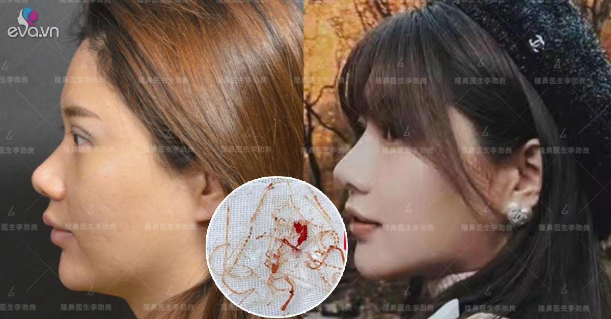 View - Muốn đẹp nhưng không đụng dao kéo, cô gái xỏ 16 sợi chỉ vào mũi và cái kết đau đớn