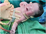 Bà bầu - Liên tiếp mổ bắt thai cho 2 sản phụ bị dây rốn thắt nút khiến bác sĩ và ê-kíp đều bất ngờ