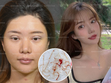 Muốn đẹp nhưng không đụng "dao kéo", cô gái xỏ 16 sợi chỉ vào mũi và cái kết đau đớn