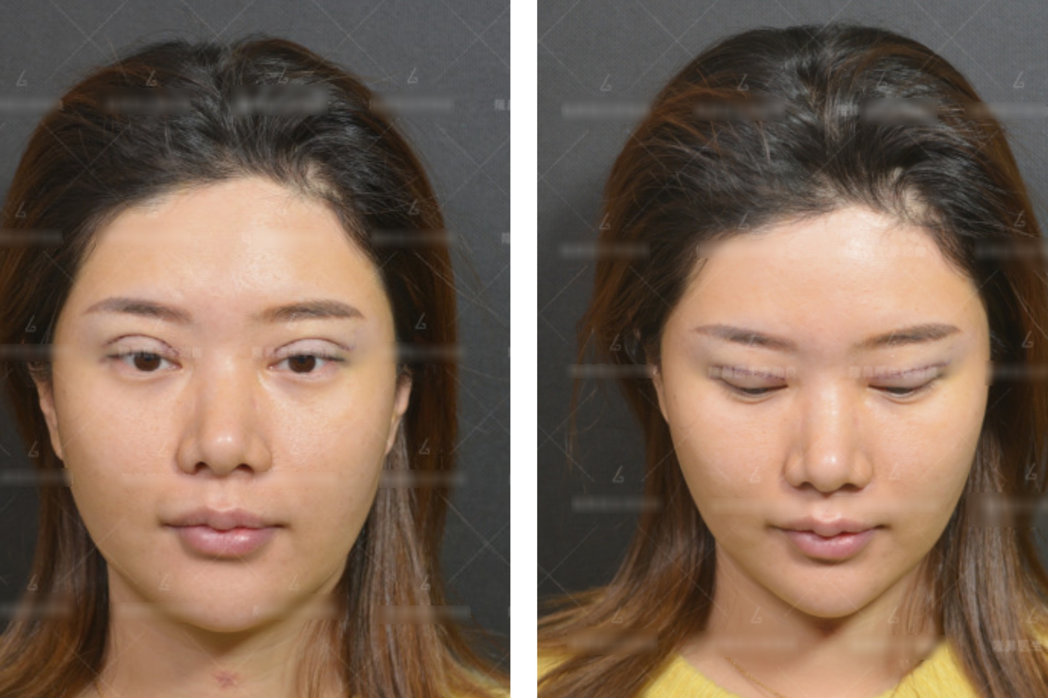 View - Muốn đẹp nhưng không đụng dao kéo, cô gái xỏ 16 sợi chỉ vào mũi và cái kết đau đớn