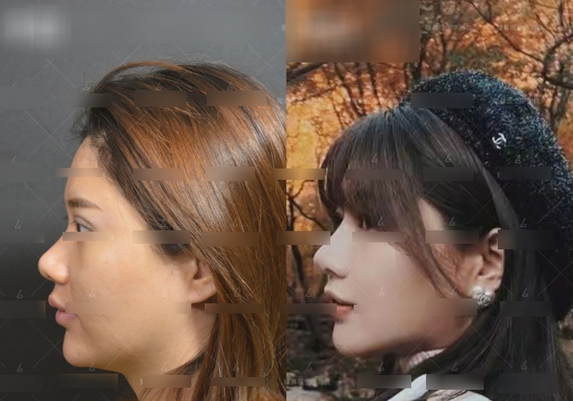 View - Muốn đẹp nhưng không đụng dao kéo, cô gái xỏ 16 sợi chỉ vào mũi và cái kết đau đớn