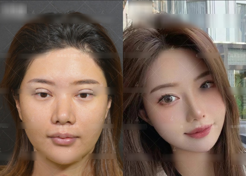 View - Muốn đẹp nhưng không đụng dao kéo, cô gái xỏ 16 sợi chỉ vào mũi và cái kết đau đớn