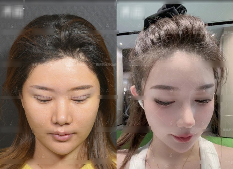 View - Muốn đẹp nhưng không đụng dao kéo, cô gái xỏ 16 sợi chỉ vào mũi và cái kết đau đớn