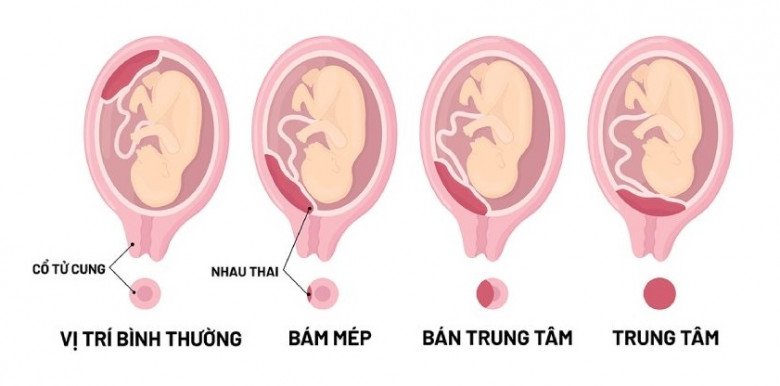 Hành trình mang thai đầy amp;#34;sóng gióamp;#34; của diễn viên Diễm Hương: Bị rau tiền đạo, ngôi ngang và cơ thể yếu xìu - 5
