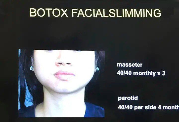 Hình ảnh của cô gái này vào 9 năm trước, khi chưa bắt đầu tiêm botox. Có thể thấy, phần cằm và hàm, đặc biệt là 2 bên cơ cắn của cô khá to.