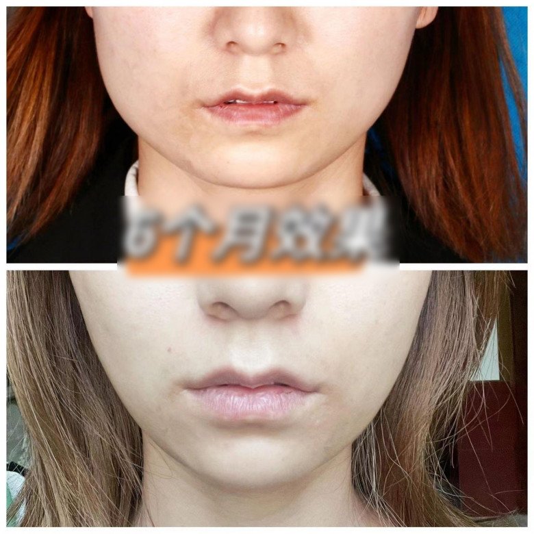 View - 10 năm tiêm botox liên tục, từ gương mặt như hình vuông thành cằm Vline, không cần phẫu thuật