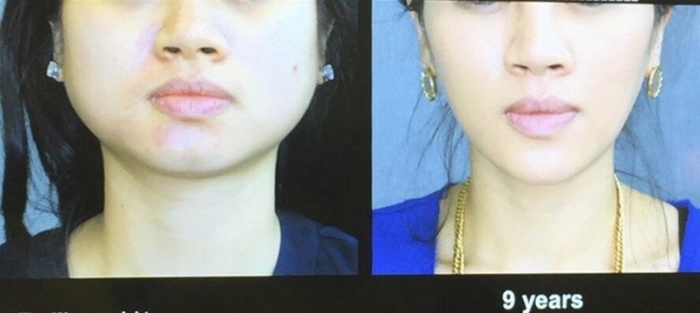 View - 10 năm tiêm botox liên tục, từ gương mặt như hình vuông thành cằm Vline, không cần phẫu thuật