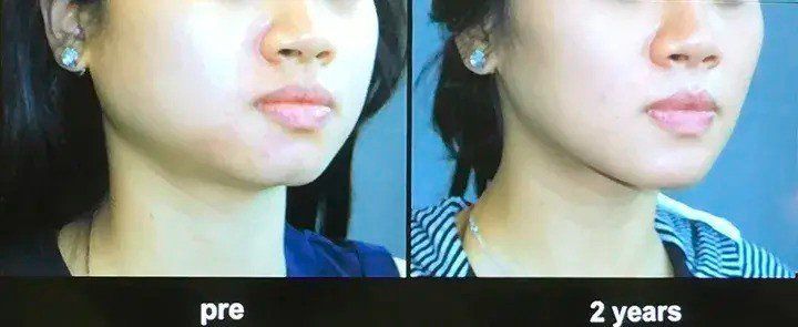 View - 10 năm tiêm botox liên tục, từ gương mặt như hình vuông thành cằm Vline, không cần phẫu thuật