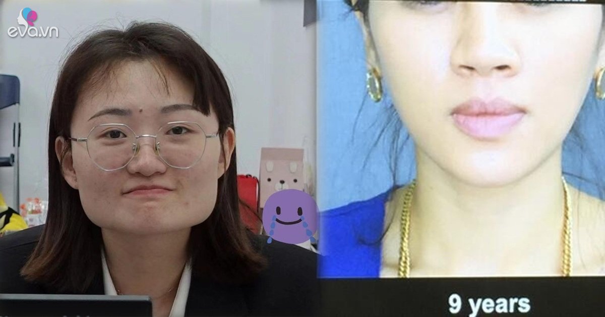 View - 10 năm tiêm botox liên tục, từ gương mặt như hình vuông thành cằm Vline, không cần phẫu thuật