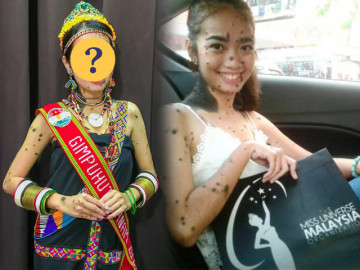 Cô gái có nốt ruồi mọc chi chít khắp cơ thể từng đi thi Hoa hậu, sau 6 năm giờ ra sao?