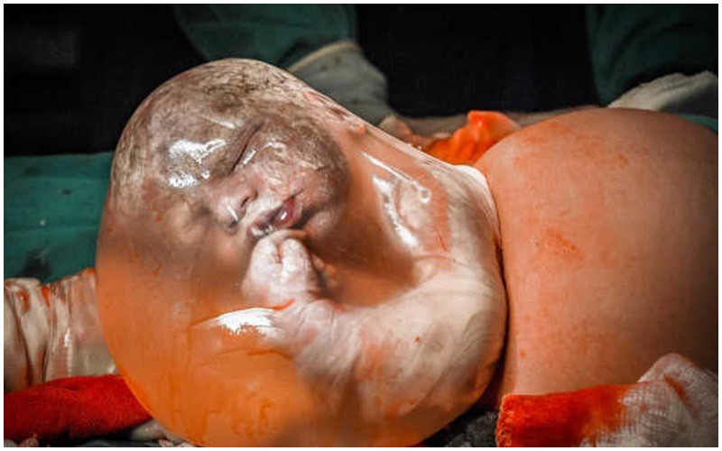 Thật thú vị khi xem bức ảnh về khoảnh khắc đứa trẻ được sinh ra trong túi ối vẫn còn nguyên vẹn. Đây là trường hợp hiếm khi xảy ra. 
