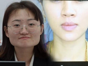 10 năm tiêm botox liên tục, từ gương mặt như hình vuông thành cằm Vline, không cần phẫu thuật
