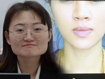 10 năm tiêm botox liên tục, từ gương mặt như hình vuông thành cằm Vline, không cần phẫu thuật