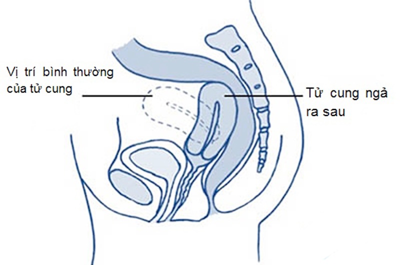 Tử cung ngả sau dễ dẫn đến các vấn đề như đau bụng kinh, lượng kinh nguyệt ra nhiều, thậm chí có thể dẫn đến vô sinh ở những trường hợp nặng. 
