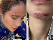 Giải trí - Tai nạn ở trường quay gameshow: Hoa hậu hoảng loạn bị flycam đập vào mặt, Vũ Hà rách da đầu chảy máu