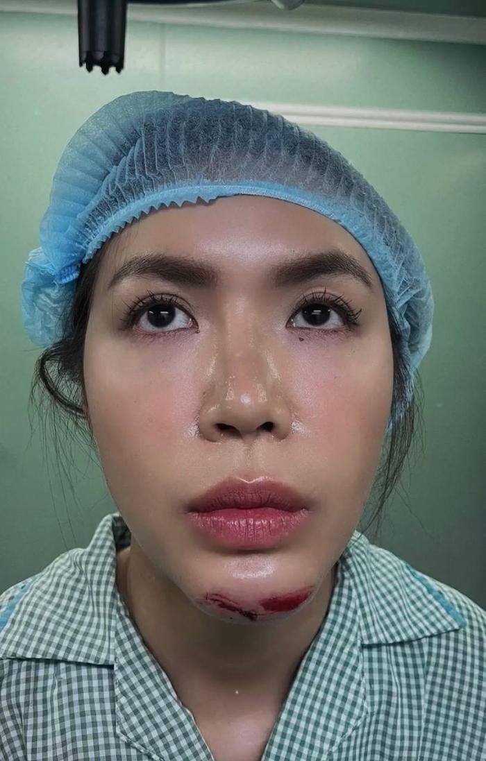 Vết thương khiến cô phải khâu 10 mũi.