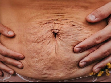 Bèo nhèo và chằng chịt vết rạn, những hình ảnh chân thật về cơ thể người mẹ sau sinh khiến ai nấy xót xa