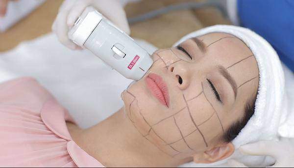 ​​​​​Được biết, chi phí của phương pháp này khoảng 30 đến 45 triệu đồng tùy từng vùng cần điều trị.