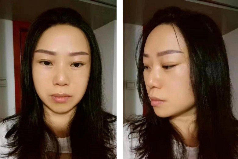 Kết quả sau 3 tháng của người phụ nữ 47 tuổi làm ai nấy không ngớt lời trầm trồ. Dù chỉ sau 3 tháng, gương mặt chưa hồi phục hoàn toàn nhưng có thể thấy rõ ràng rằng từ một gương mặt chảy xệ, giờ đây, cô trông trẻ trung như gái đôi mơi với làn da căng mịn của mình.