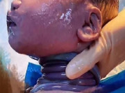 Hình ảnh những em bé sinh ra với nhiều vòng dây rốn quấn cổ gây ngạc nhiên cho cả ê kip đỡ đẻ