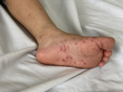Sức khỏe - Dịch tay chân miệng lây nhiễm trong trường học ở Hà Nội