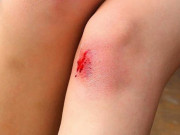 Sức khỏe - Thiếu niên khỏe mạnh suýt mất chân từ vết xước nhỏ, bác sĩ cảnh báo mầm bệnh nguy hiểm trong cộng đồng