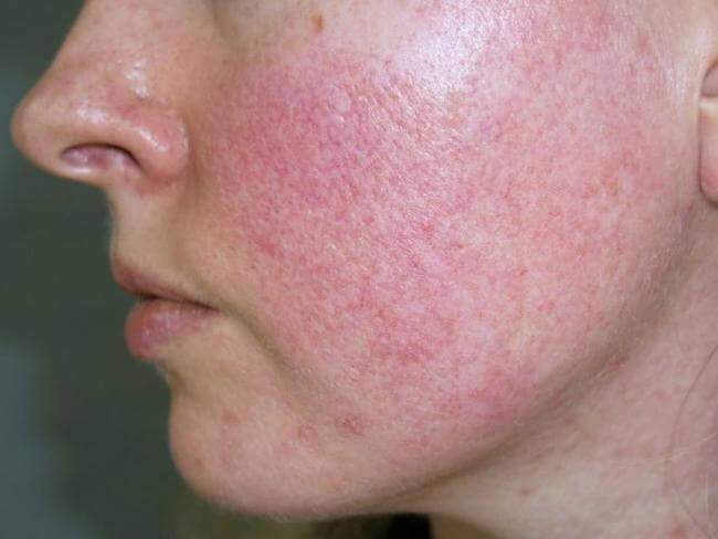 Dấu hiệu làn da bị nhiễm Corticoid với nhiều triệu chứng mẩn đỏ, nổi mụn, sưng tấy. 